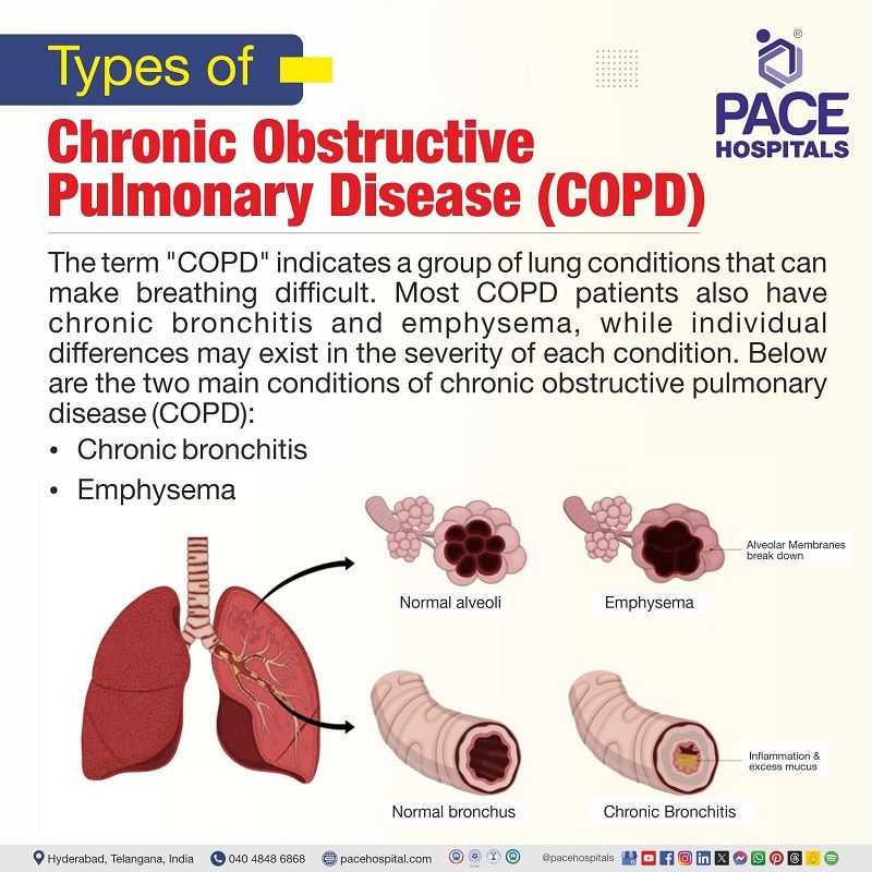 Types of COPD Types of COPD | 4 types of COPD | types of COPD diseases | COPD types | visual showing the types of COPD | What are the different types of COPD