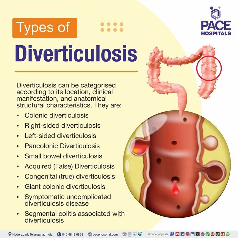 Types of Diverticulosis | Diverticulosis Types