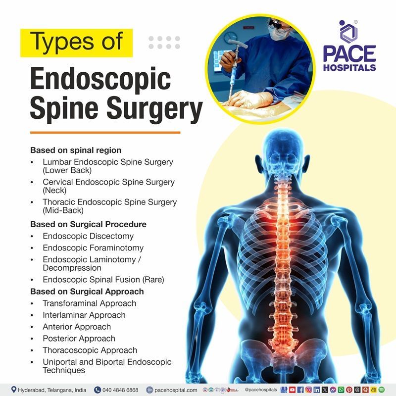 Endoscopic Surgery Types illustration of spine highlighting regions for endoscopic surgery types |
