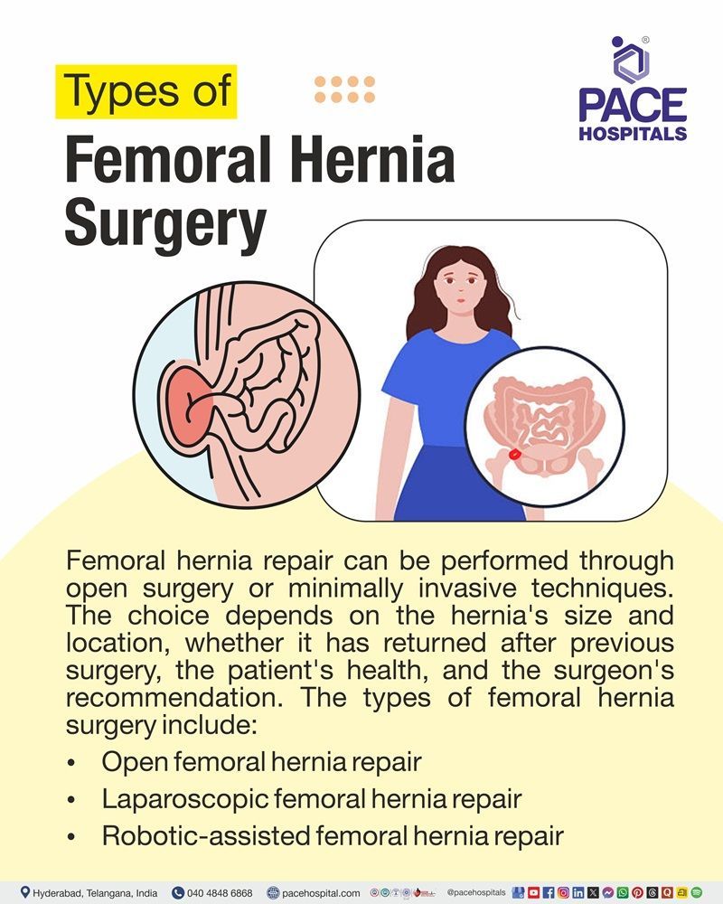 Types of Femoral Hernia Surgery Types of femoral hernia surgery including open, laparoscopic and robotic-assisted femoral hernia repair