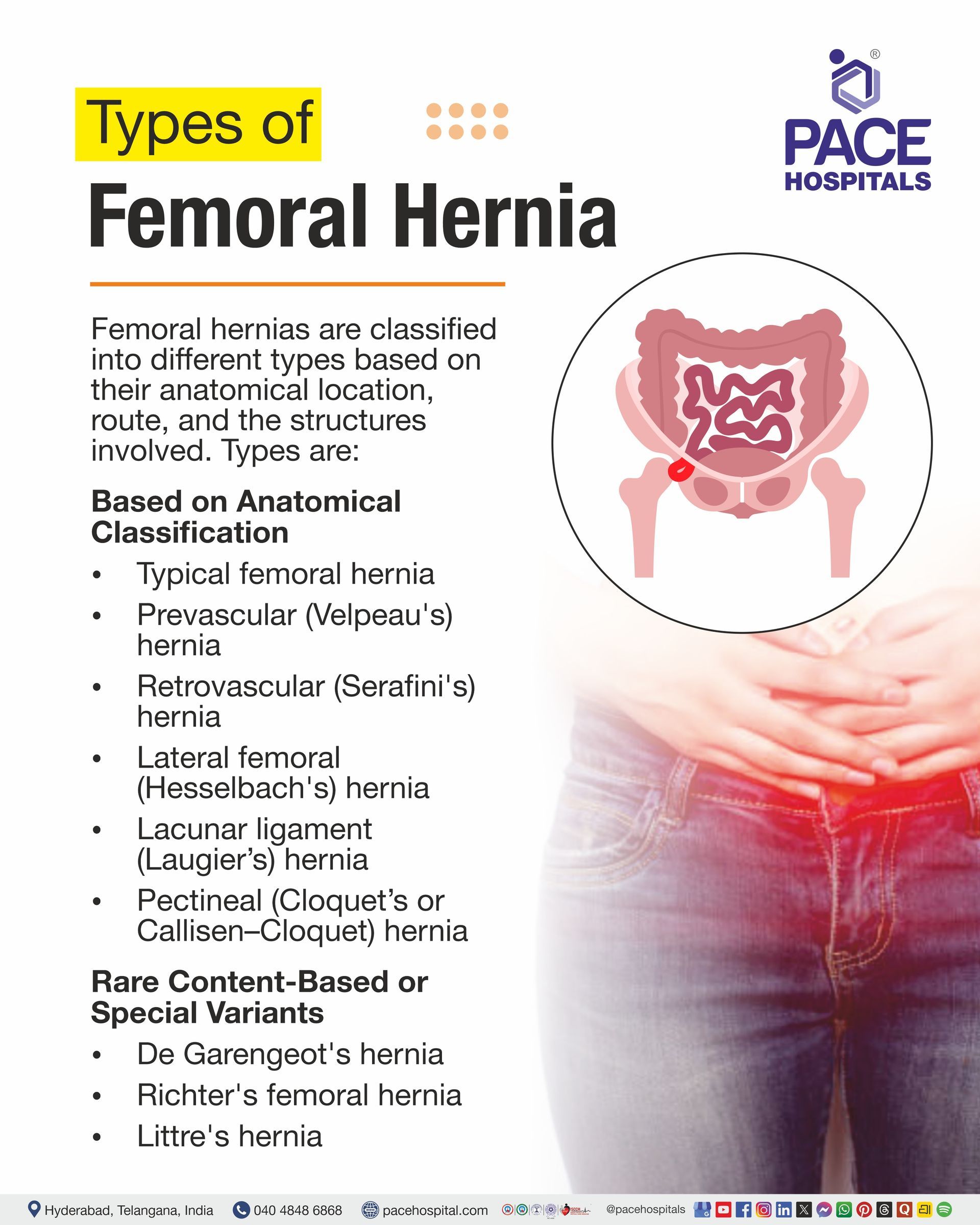 Types of Femoral Hernia I Femoral Hernia Types 
