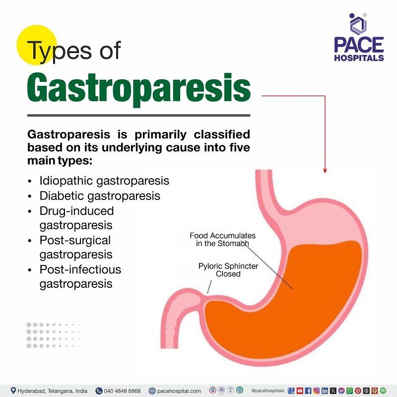 Types of Gastroparesis Types of Gastroparesis | Different Types of Gastroparesis | Gastroparesis Types