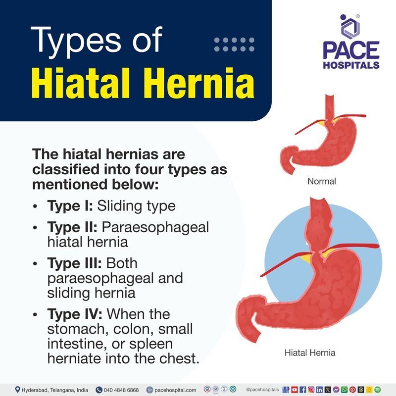 type 4 hiatal hernia | type 2 hiatal hernia | sliding type hiatal hernia | Visual shoeing the types of Hiatal hernia