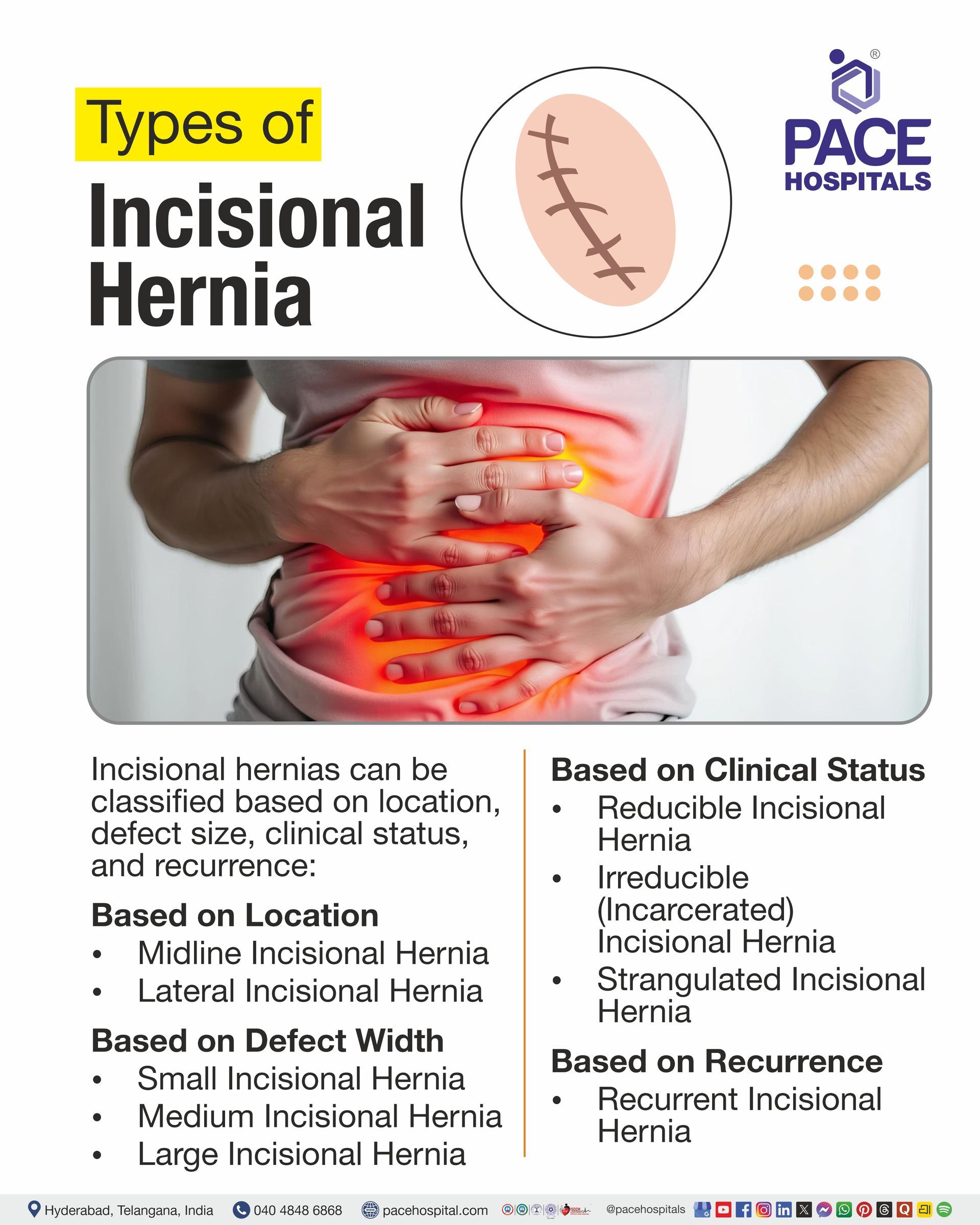 Types of Incisional Hernia I Incisional Hernia Types 