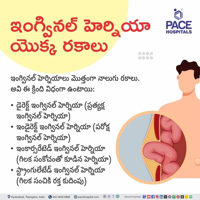 Types of Inguinal hernia Types of Inguinal hernia in Telugu | Inguinal hernia types | What are the types of Inguinal hernia