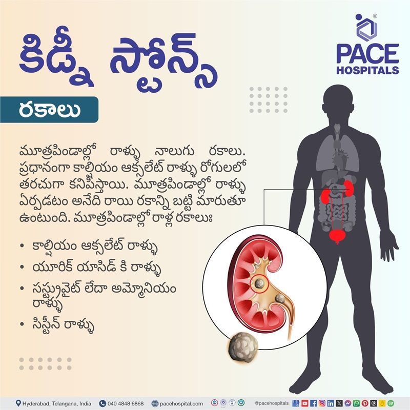 Types of kidney stones | kidney stone types | different types of kidney stones | most common type of kidney stone | Visual depicting different types of kidney stones
