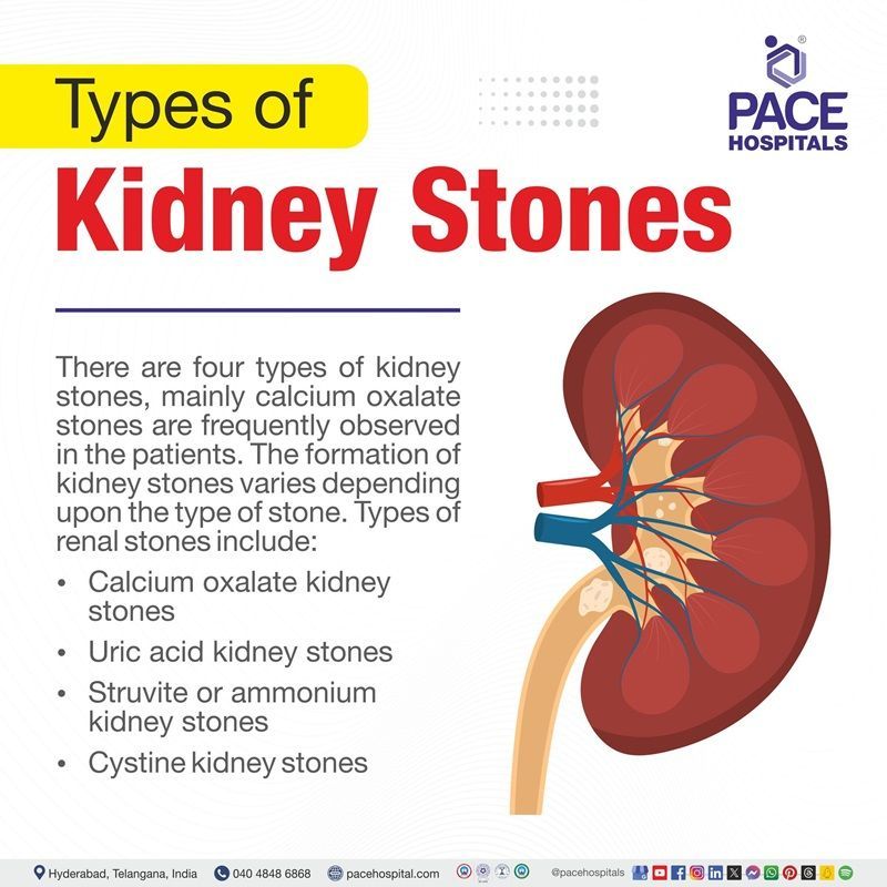 Types of Kidney Stones Types of kidney stones | kidney stone types | different types of kidney stones | most common type of kidney stone | Visual depicting different types of kidney stones