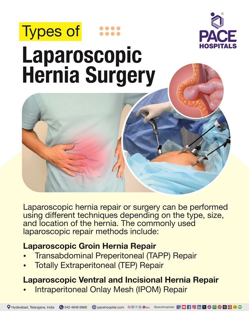 Laparoscopic hernia surgery types Common laparoscopic hernia repair techniques, including TAPP, TEP, and IPOM approaches.