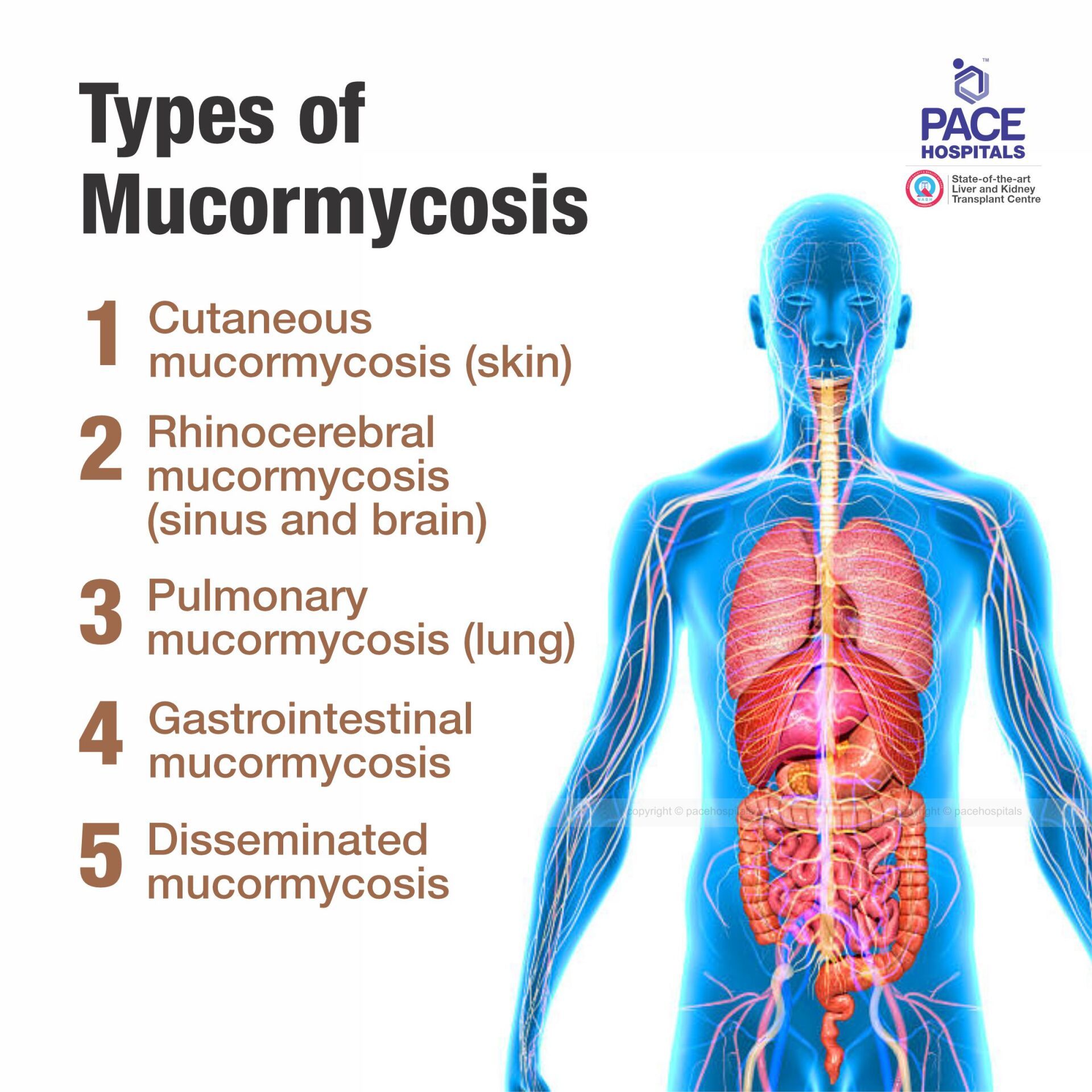 Types of Mucormycosis - Pulmonary mucormycosis (lung), Rhinocerebral mucormycosis (sinus and brain), Cutaneous mucormycosis (skin), Gastrointestinal mucormycosis, Disseminated mucormycosis Types of Mucormycosis - Pulmonary mucormycosis (lung), Rhinocerebral mucormycosis (sinus and brain), Cutaneous mucormycosis (skin), Gastrointestinal mucormycosis, Disseminated mucormycosis