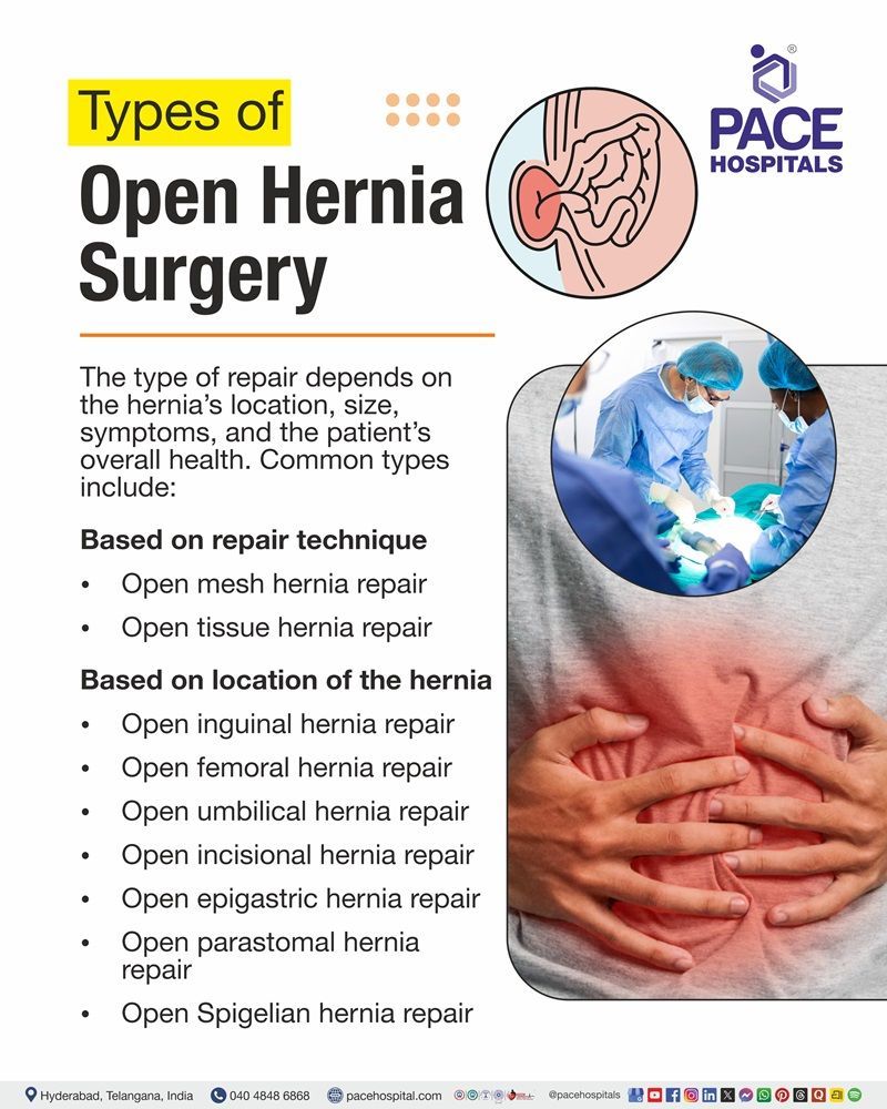 Open hernia surgery Types Common open hernia repair techniques categorized by repair method and hernia location.