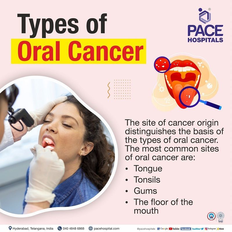 Types of oral cancer | Different types of oral cancer | Oral cancer types 