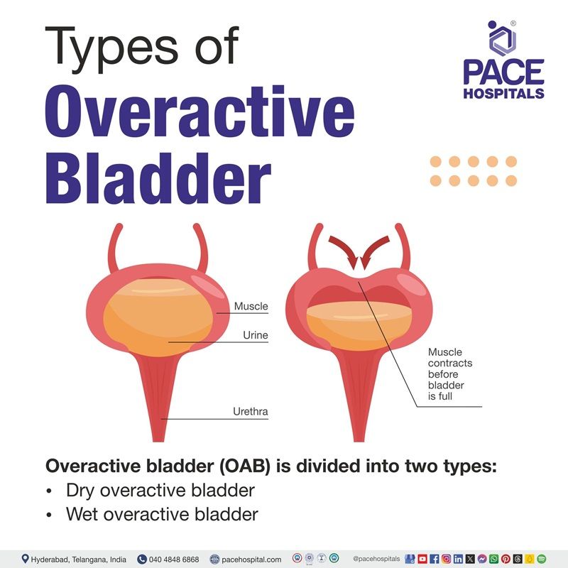 Types of overactive bladder | Over active bladder types | What are the different types of Overactive bladder | Visual depicting the different types of Overactive bladder