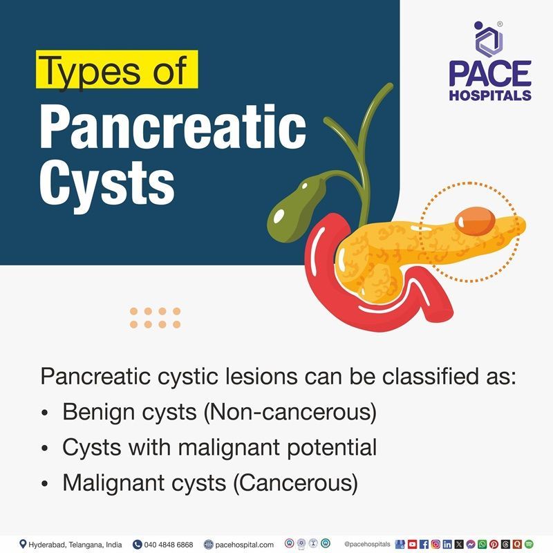 Types of Pancreatic Cysts Types of Pancreatic Cysts | Image showing Pancreatic Cysts types