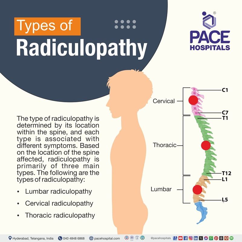 Types of Radiculopathy | Radiculopathy types