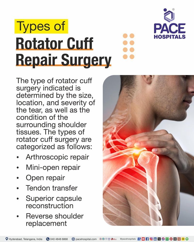 Types of Rotator Cuff Repair Surgery Overview of different rotator cuff repair techniques, including arthroscopic, mini-open, and open repair, tendon transfer, and other surgical options.
