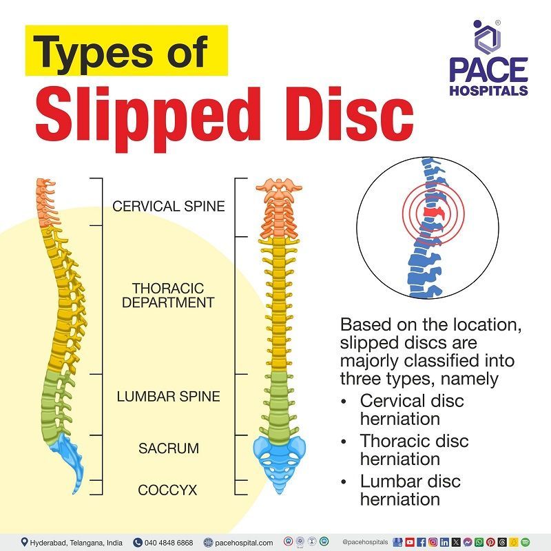 Slipped disc (Herniated disk) types Types of slip disc | types of disc herniation | types of lumbar disc herniation | Visual depicting the different types of Slipped Disc