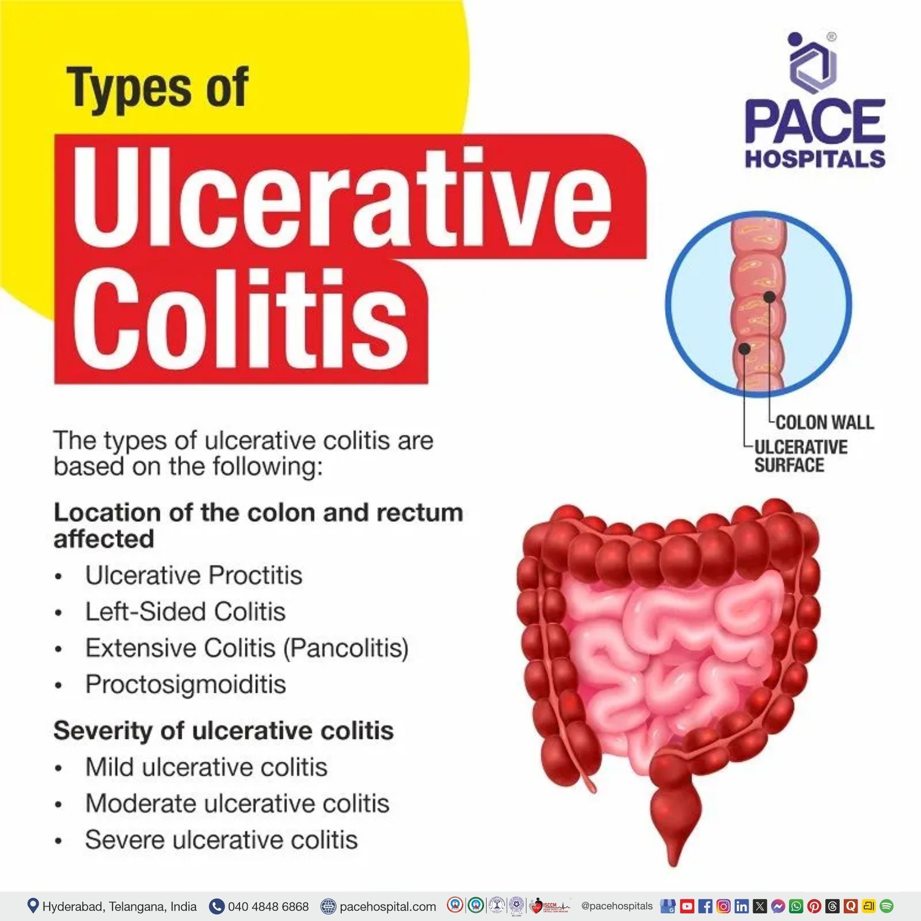 different types of ulcerative colitis | ulcerative colitis types