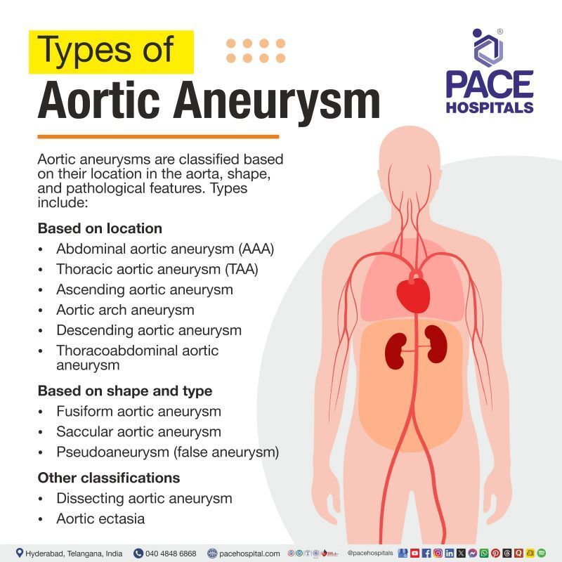 Types of Aortic Aneurysm Types of Aortic Aneurysm | Most common type of aortic aneurysm | Aortic aneurysm types