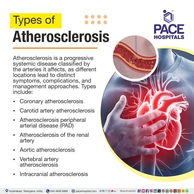 Types of Atherosclerosis Types of Atherosclerosis | Different types of atherosclerosis | Atherosclerosis