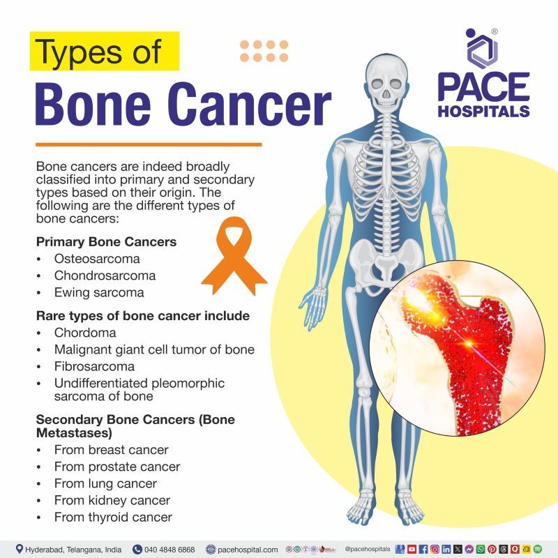 Types of Bone Cancer Types of Bone Cancer | Different types of bone cancer | Bone cancer types list
