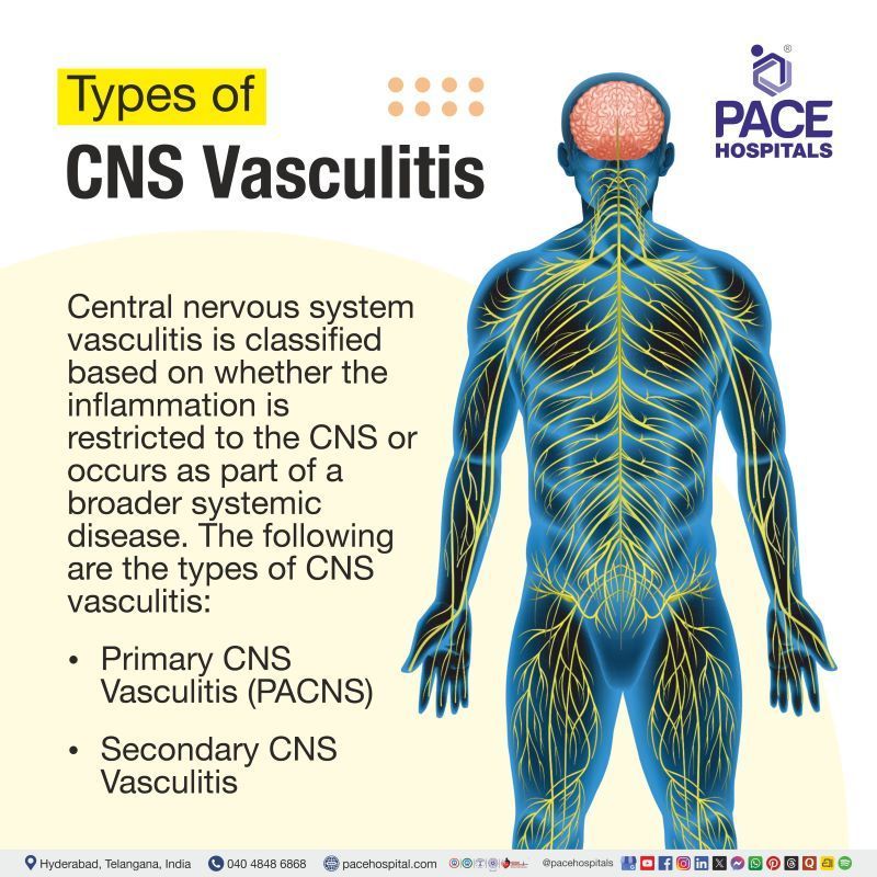 Central Nervous System (CNS) Vasculitis Types CNS vasculitis types | Central Nervous System Vasculitis Types | Types of CNS vasculitis