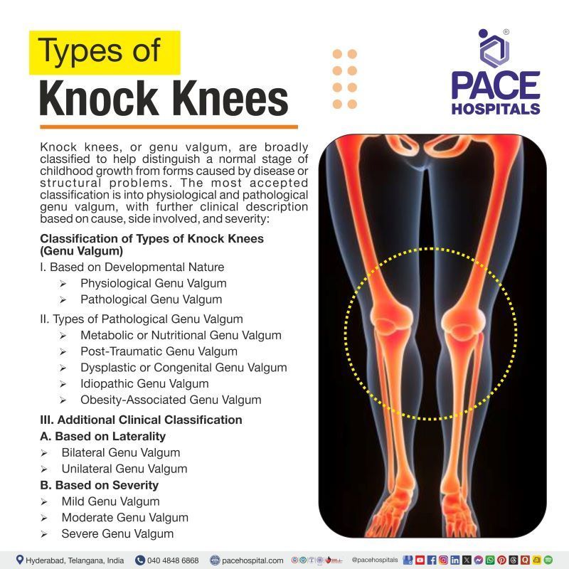Types of Knock Knees ( Genu Valgum) Types of Knock Knees | Knock knees types | All types of knock knees | Genu Valgum Types