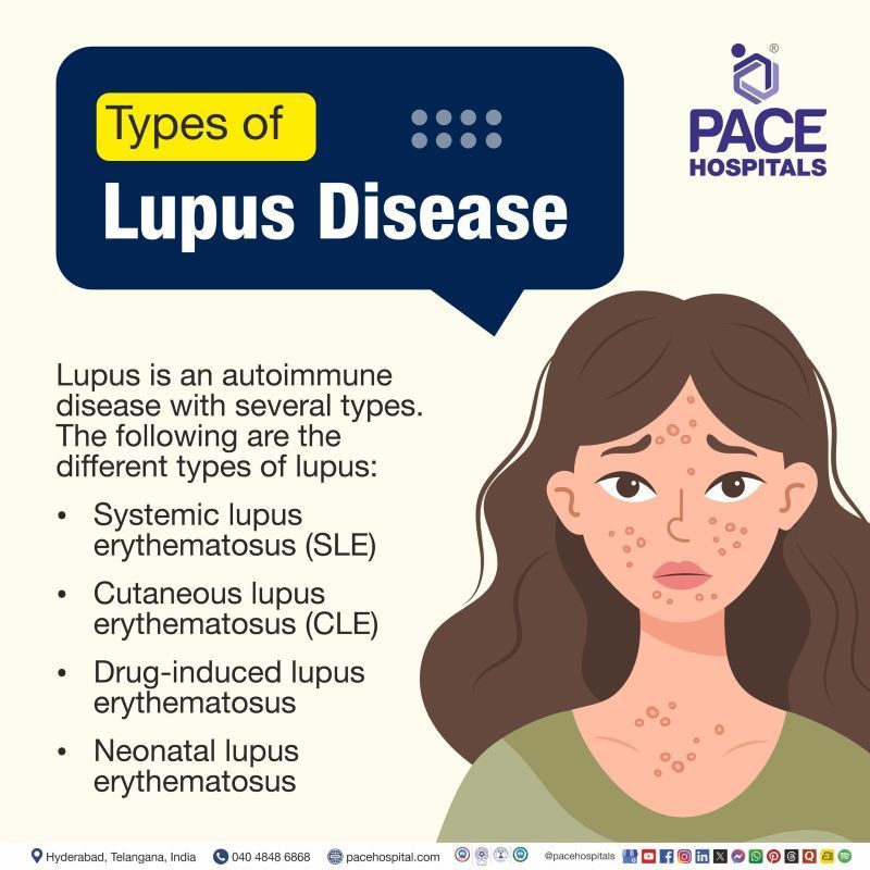 Types of Lupus Types of Lupus | What are the 4 types of lupus | Lupus types