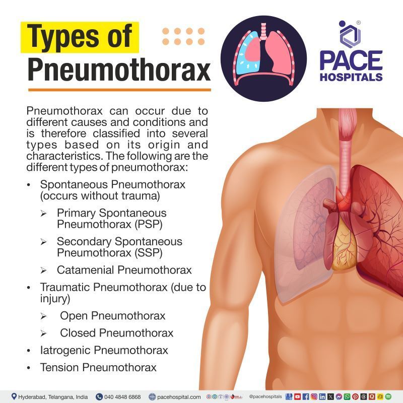 Types of Pneumothorax Types of Pneumothorax | Different types of pneumothorax | Pneumothorax types