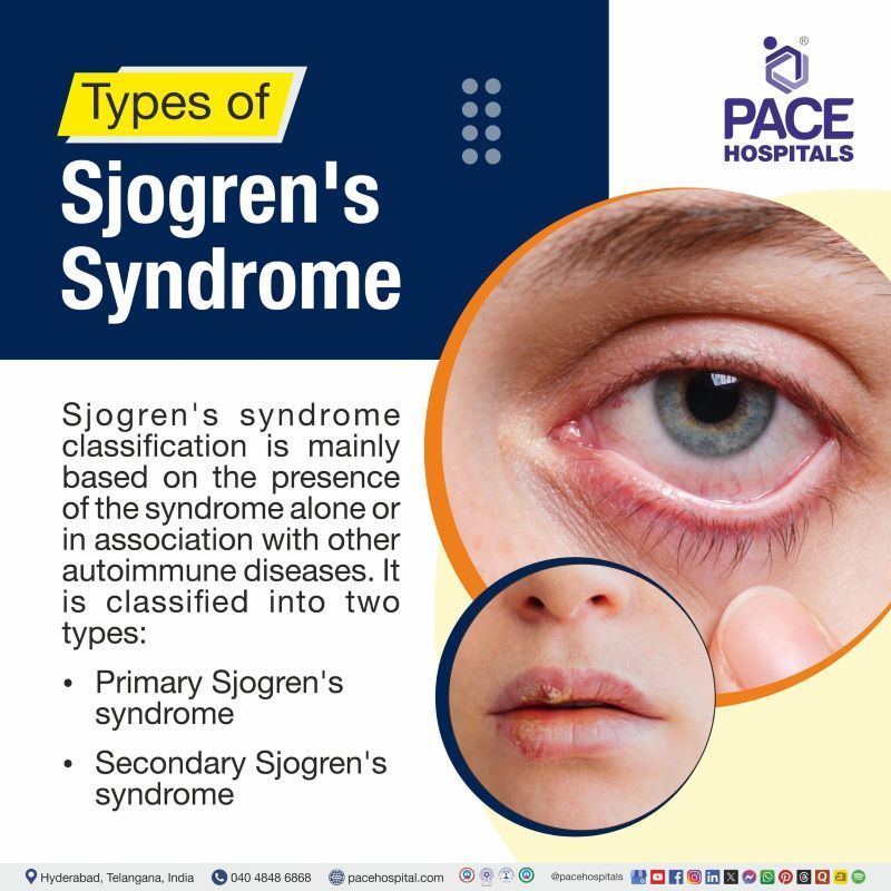 Types of Sjogren's Syndrome Types of Sjogren's Syndrome | Different types of sjogren's syndrome | Sjogren's syndrome types
