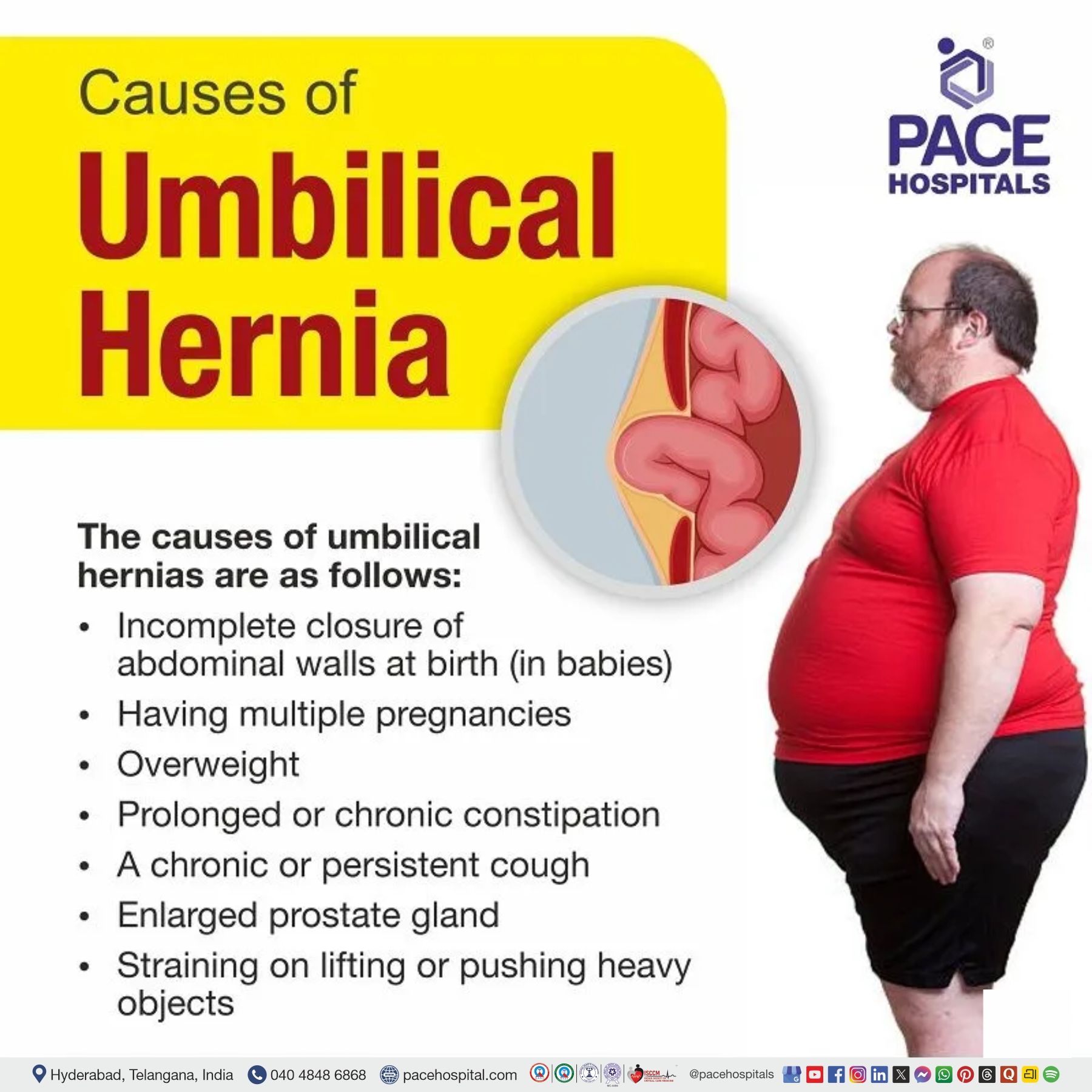 causes of umbilical hernia, India | reason for umbilical hernia | etiology of umbilical hernia | causes of umbilical hernia in newborn | what causes umbilical hernia in adults