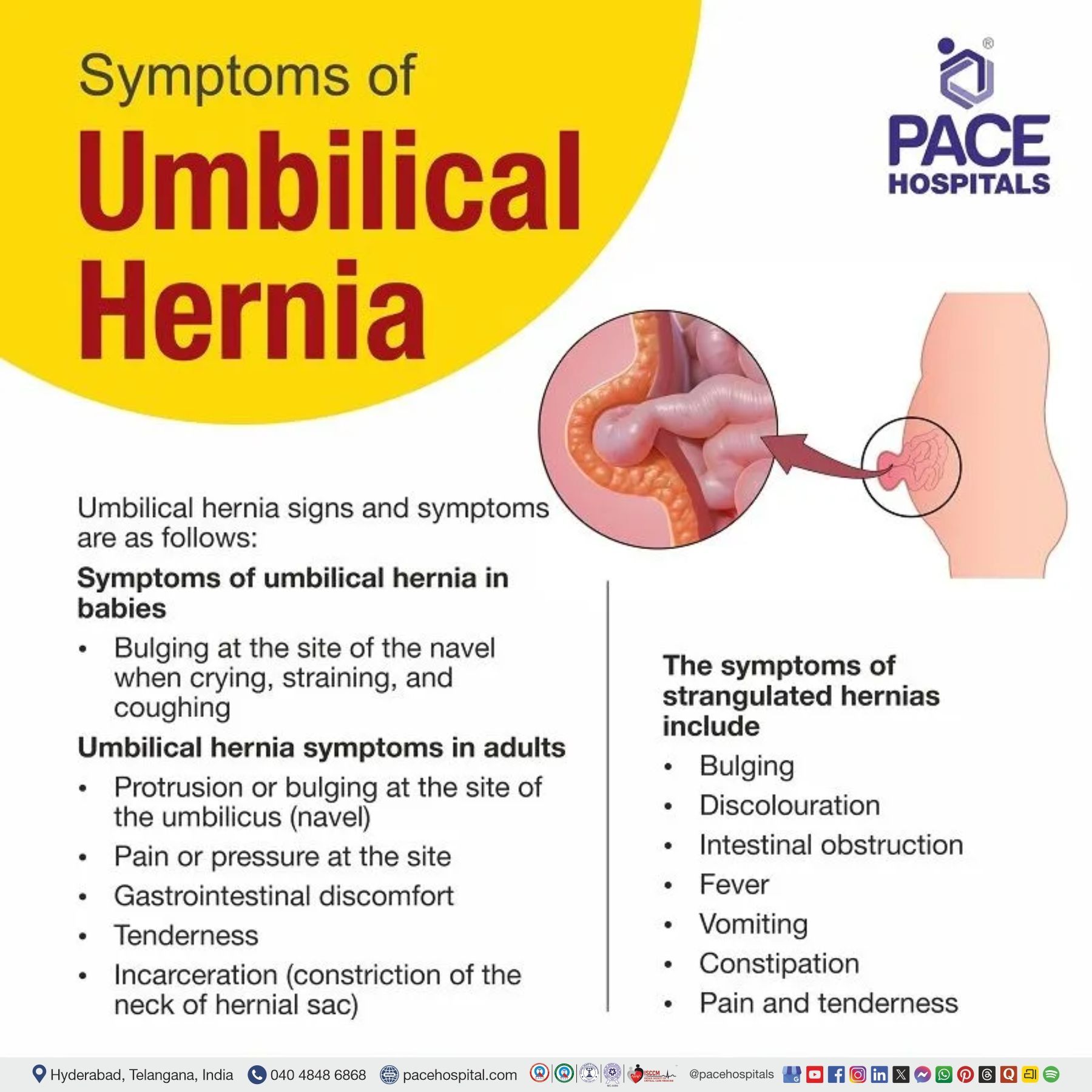 symptoms of umbilical hernia, India | signs of umbilical hernia | umbilical hernia symptoms in newborns | symptoms of umbilical hernia in adults | strangulated umbilical hernia symptoms | paraumbilical hernia symptoms