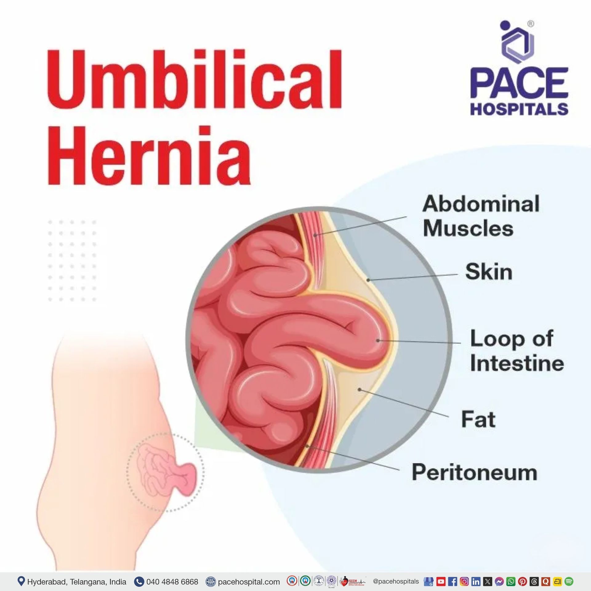 what is umbilical hernia | umbilical hernia meaning | umbilical hernia definition | umbilical hernia pictures | umbilical hernia images | introduction of umbilical hernia