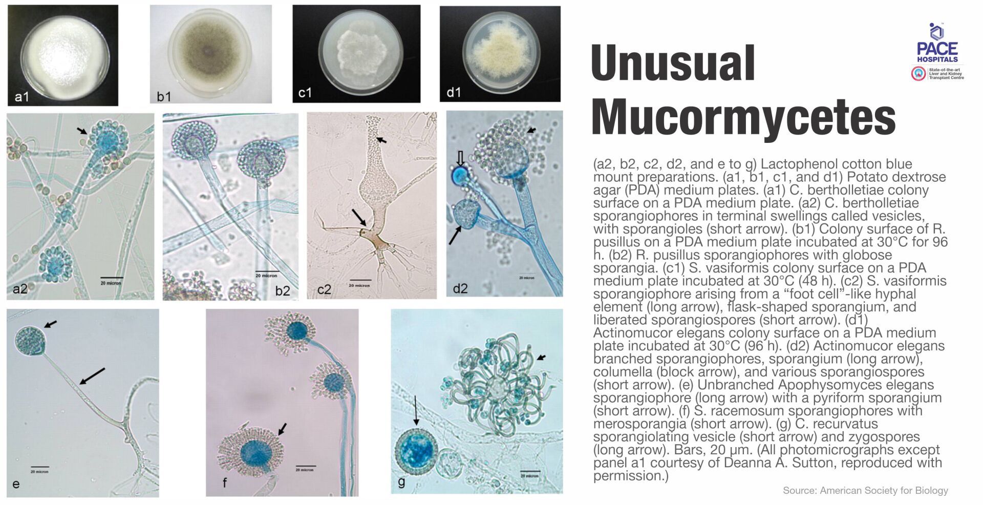 Unusual Mucormycetes caused Mucormycosis Unusual Mucormycetes caused Mucormycosis