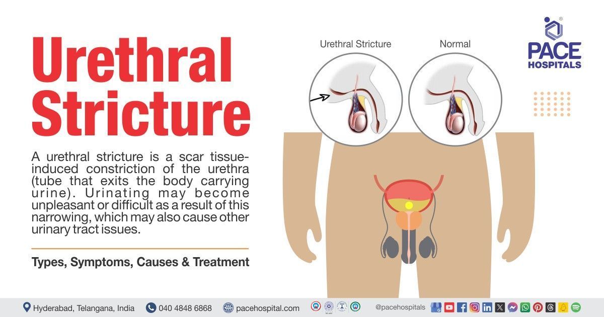Urethral stricture | Urethral stricture treatment in India | Urethral stricture symptoms & causes