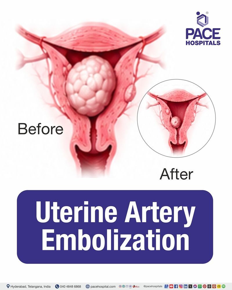 Uterine Artery Embolization Cost in Hyderabad | Affordable Uterine Artery Embolization in India