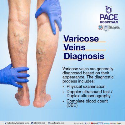 Varicose Veins Diagnosis varicose veins diagnosis in hyderabad | doppler ultrasound | duplex ultrasonography