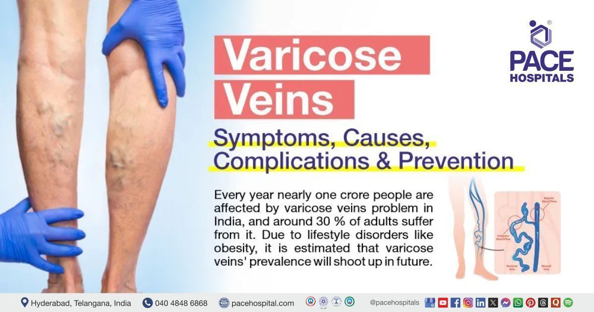 Varicose Veins Symptoms, Causes, Complications and Treatment