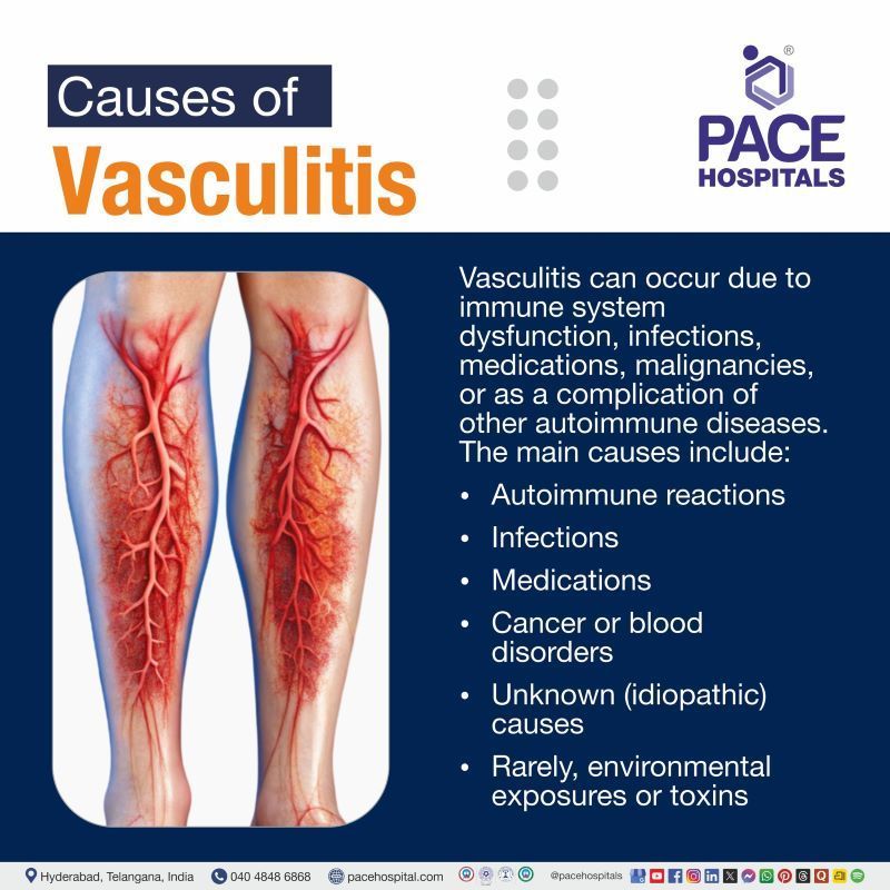 Vasculitis Causes Vasculitis Causes | What causes vasculitis | Cause for vasculitis
