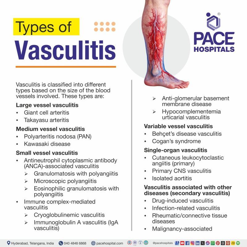 Vasculitis Types Vasculitis Types | Vasculitis disease types | Vasculitis types pictures | Types of vasculitis pictures