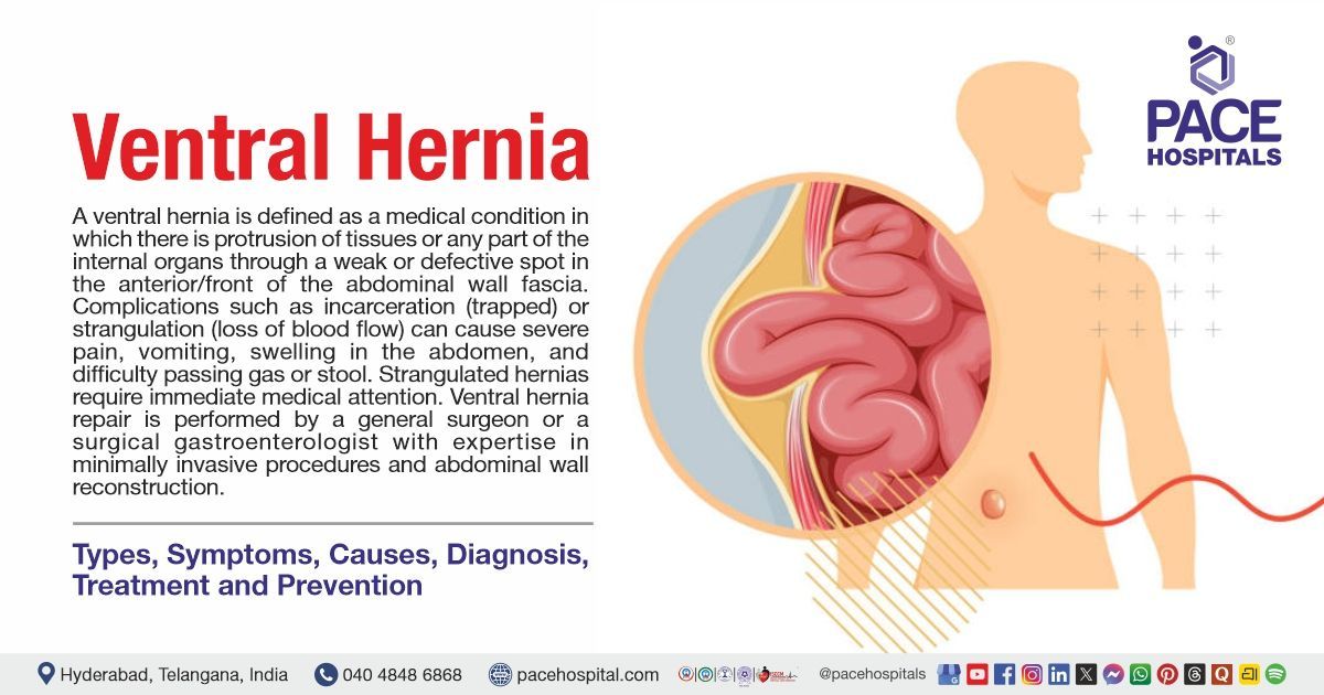 Ventral hernia types, symptoms, causes and treatment 