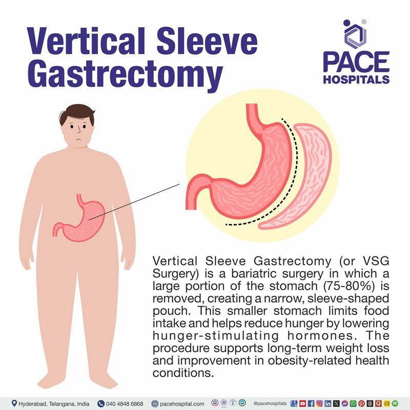What is Vertical Sleeve Gastrectomy (VSG)? What is a sleeve gastrectomy | What is vertical sleeve gastrectomy (VSG)
