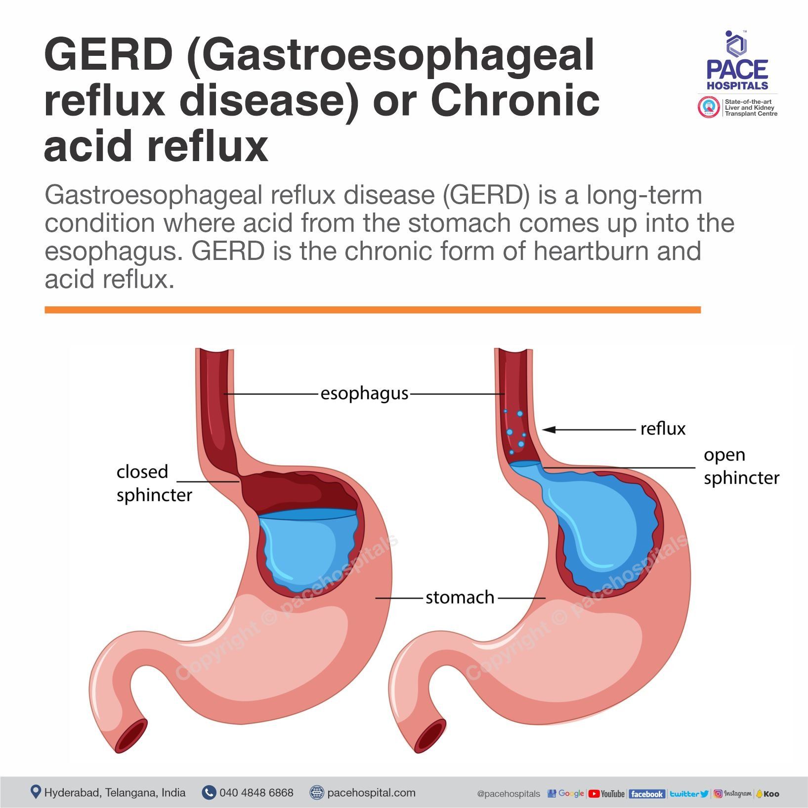 What is GERD (Gastroesophageal reflux disease) or chronic acid reflux What is GERD (Gastroesophageal reflux disease) or chronic acid reflux