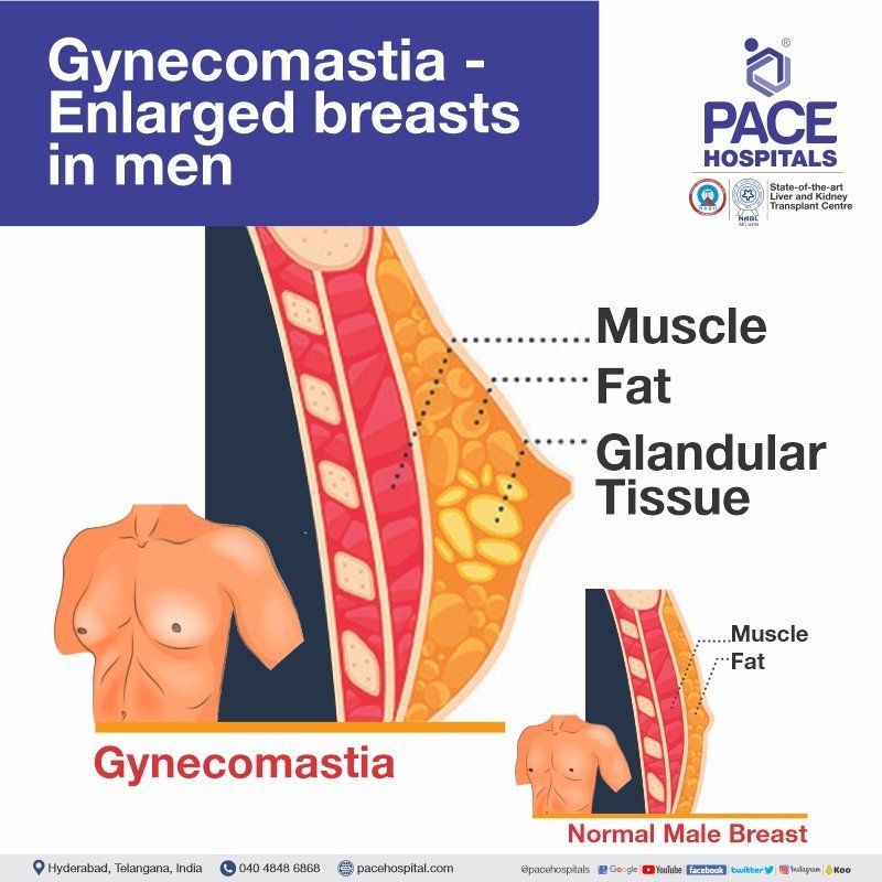 gynecomastia | gynaecomastia what is gynecomastia | gynaecomastia