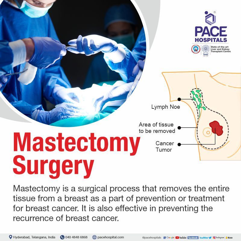 Mastectomy Surgery in Hyderabad What is Mastectomy Surgery | Radical mastectomy surgery in India