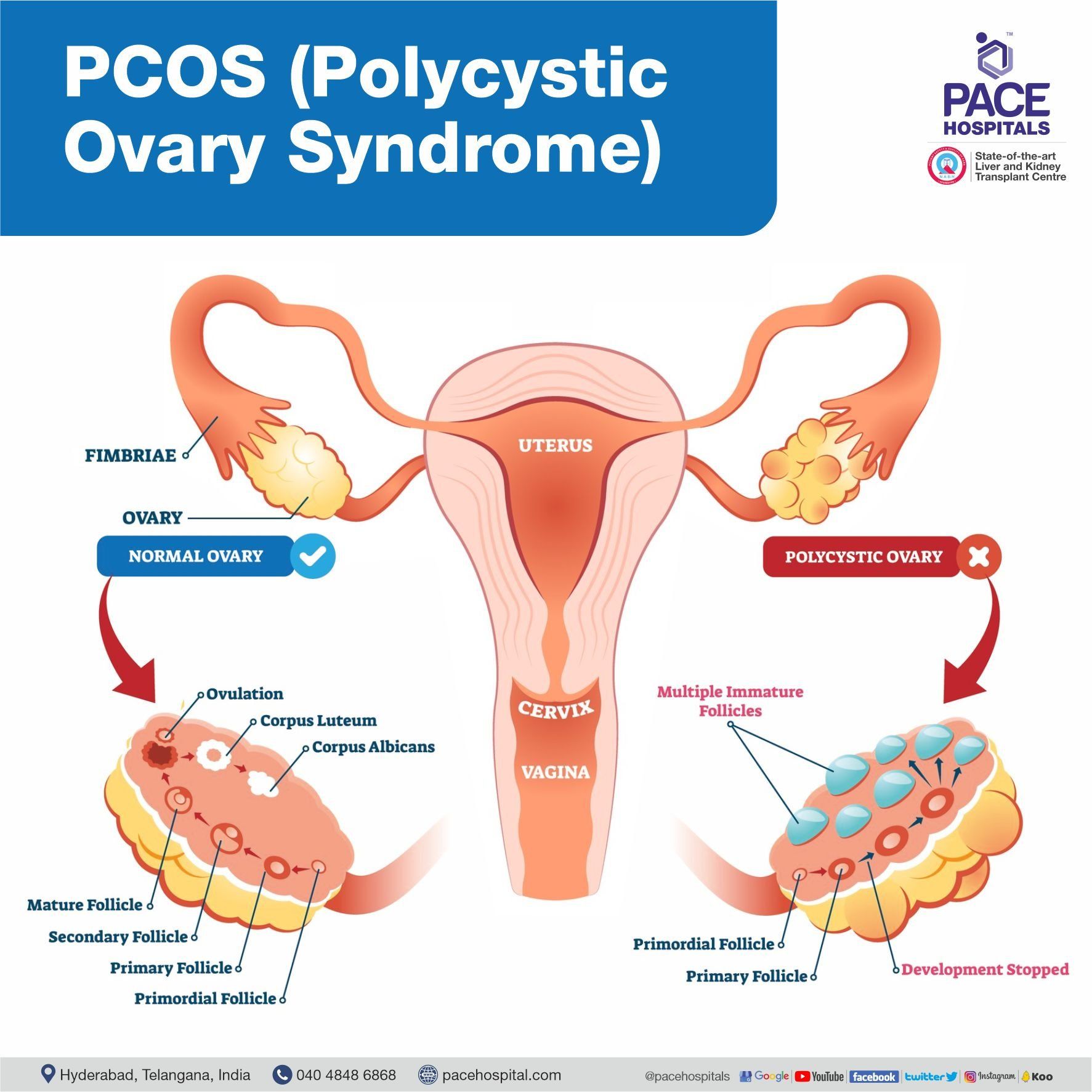 What is PCOS (Polycystic Ovary Syndrome) and PCOD (Polycystic Ovarian Disease)