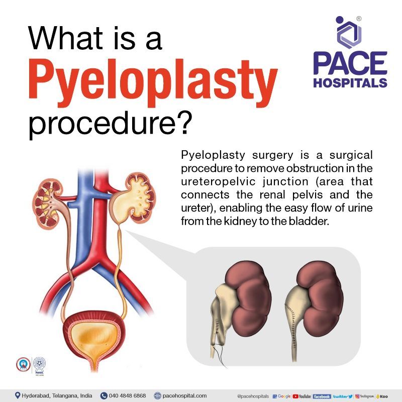 pyeloplasty surgery for UPJ obstruction in Hyderabad | laparoscopic pyeloplasty surgery what is pyeloplasty procedure | pyeloplasty surgery in hyderabad | pyeloplasty surgery cost in India