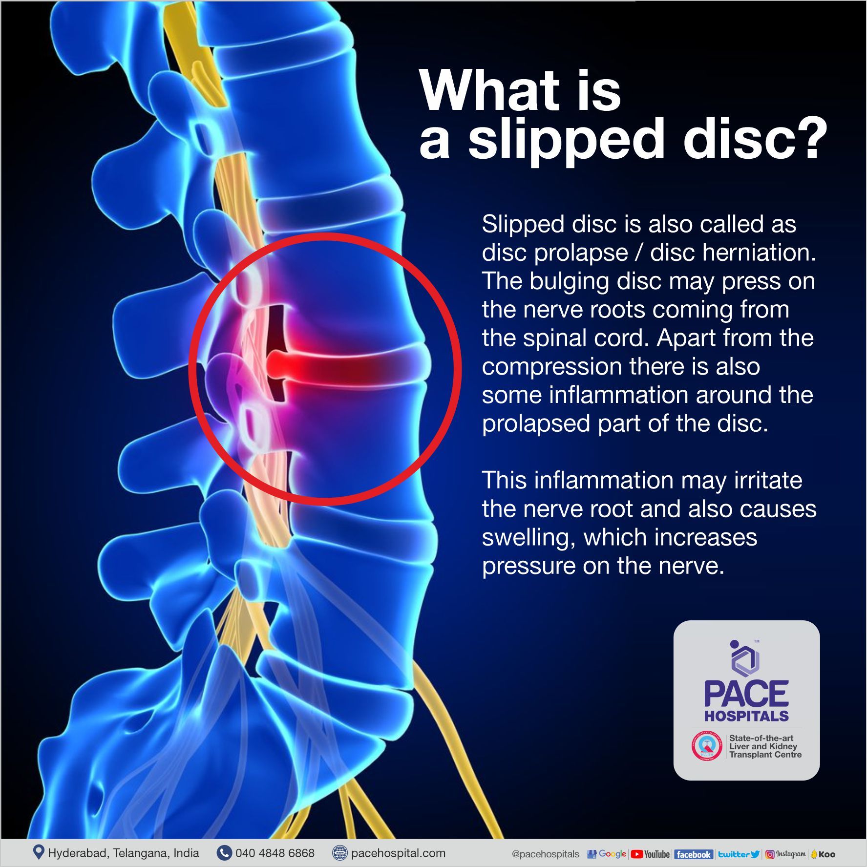 What is Slipped Disc - Definition What is Slipped Disc - Definition