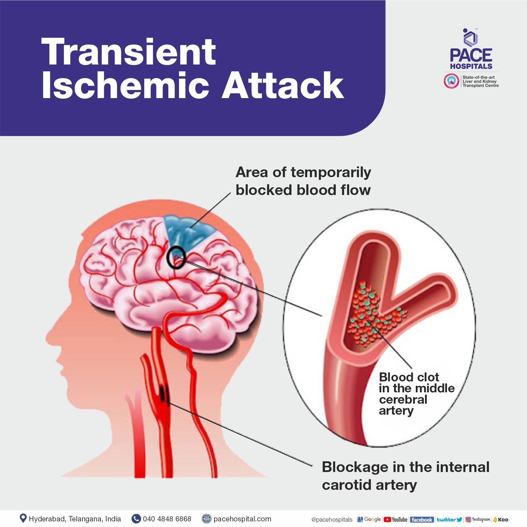 What is transient ischemic attack (TIA) | ischemic brain stroke | Brain stroke | Visual showing blood blockage in Transient Ischemic attack condition in the brain