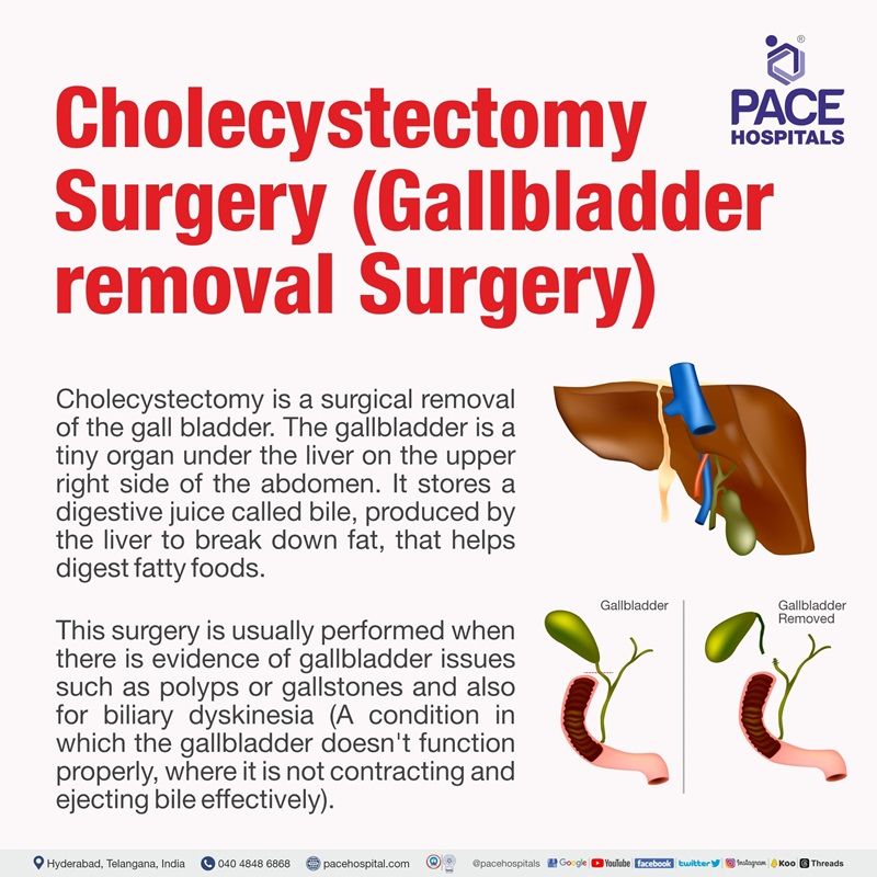 best hospital for gallbladder surgery in hyderabad | Best Hospital for gallbladder removal surgery in Hyderabad | cholecystectomy surgery in India | laparoscopic gallbladder surgery cost | laparoscopic cholecystectomy cost