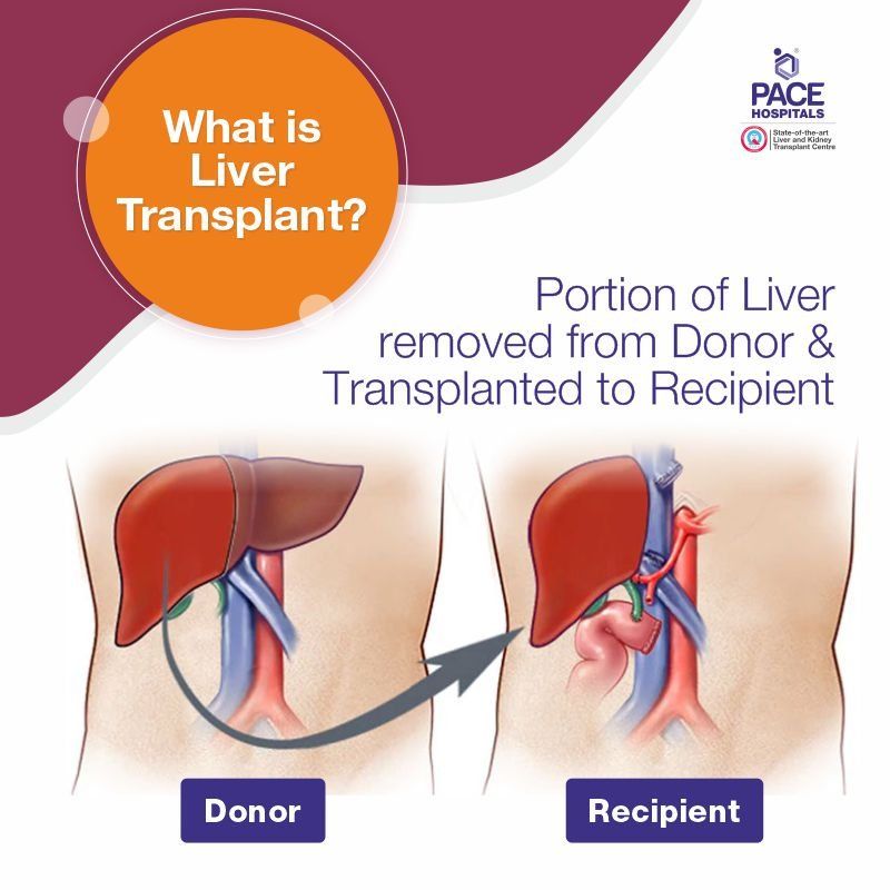 What is Liver Transplant Surgery? Liver transplant surgery meaning | liver transplant procedure in Hyderabad India